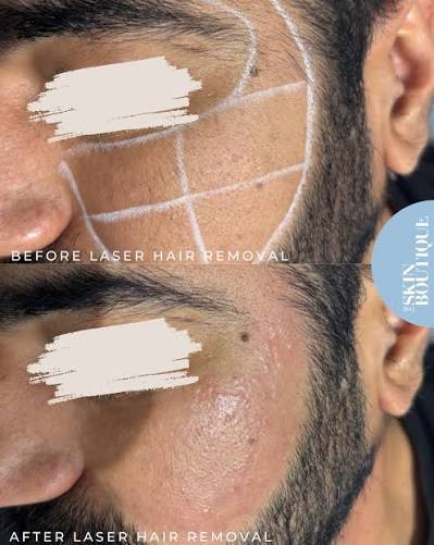 How Engaging In Laser Hair Removal Services Esthetics Center Transforms Your Skin